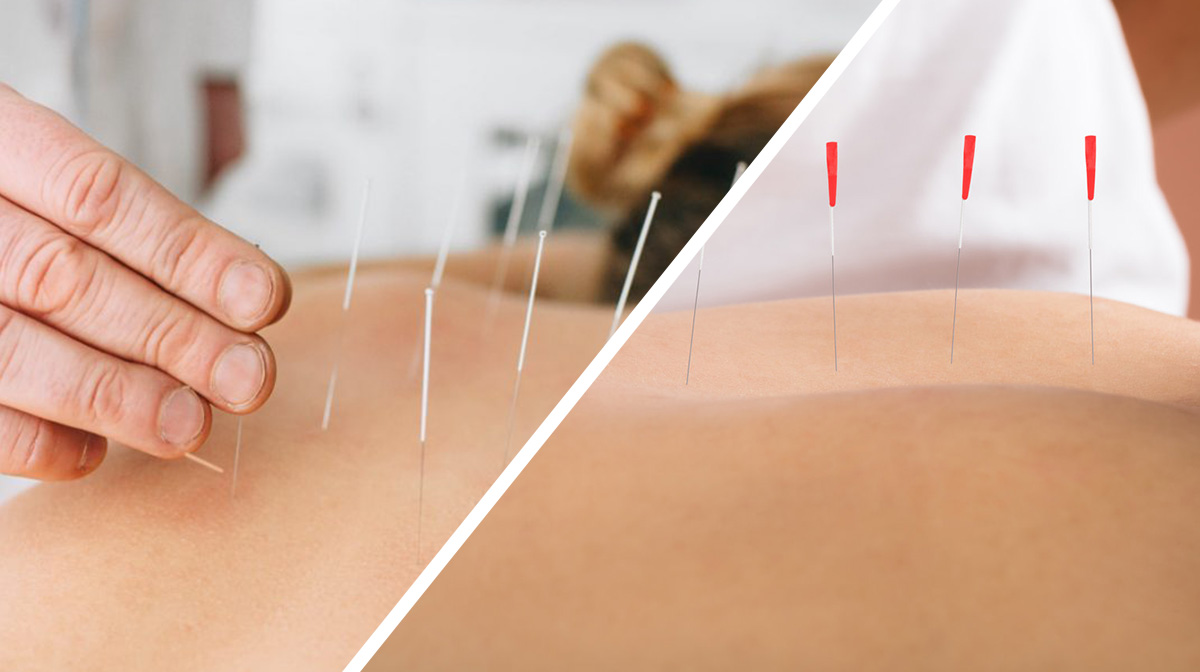 Who Is Allowed to Perform Dry Needling and Why That Matters