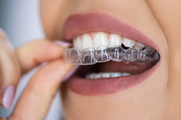 7 Benefits of Invisalign: Straight teeth Without Braces