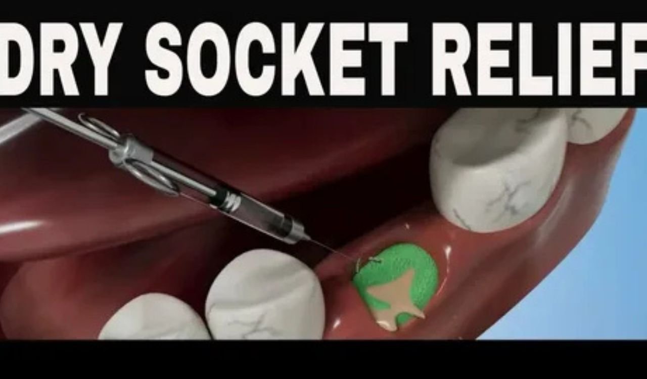 Dry Socket Heal Naturally: Home Remedies & Recovery Guide