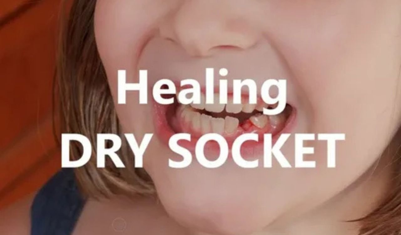 Does Dry Socket Heal and How Long Does It Take? Complete Recovery Timeline Does Dry Socket Heal and How Long Does It Take? Complete Recovery Timeline
