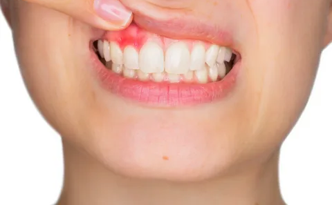 How Long Until A Tooth Infection Spreads