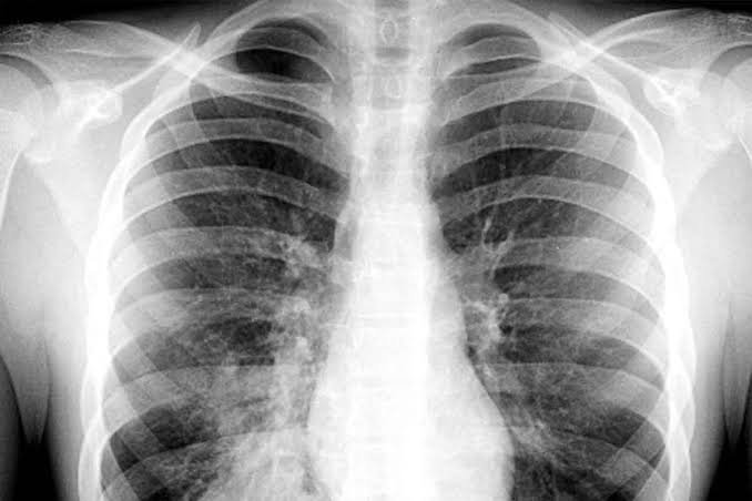 PNA Medical Abbreviation: What It Means and Why It Matters in Healthcare PNA Medical Abbreviation: What It Means and Why It Matters in Healthcare